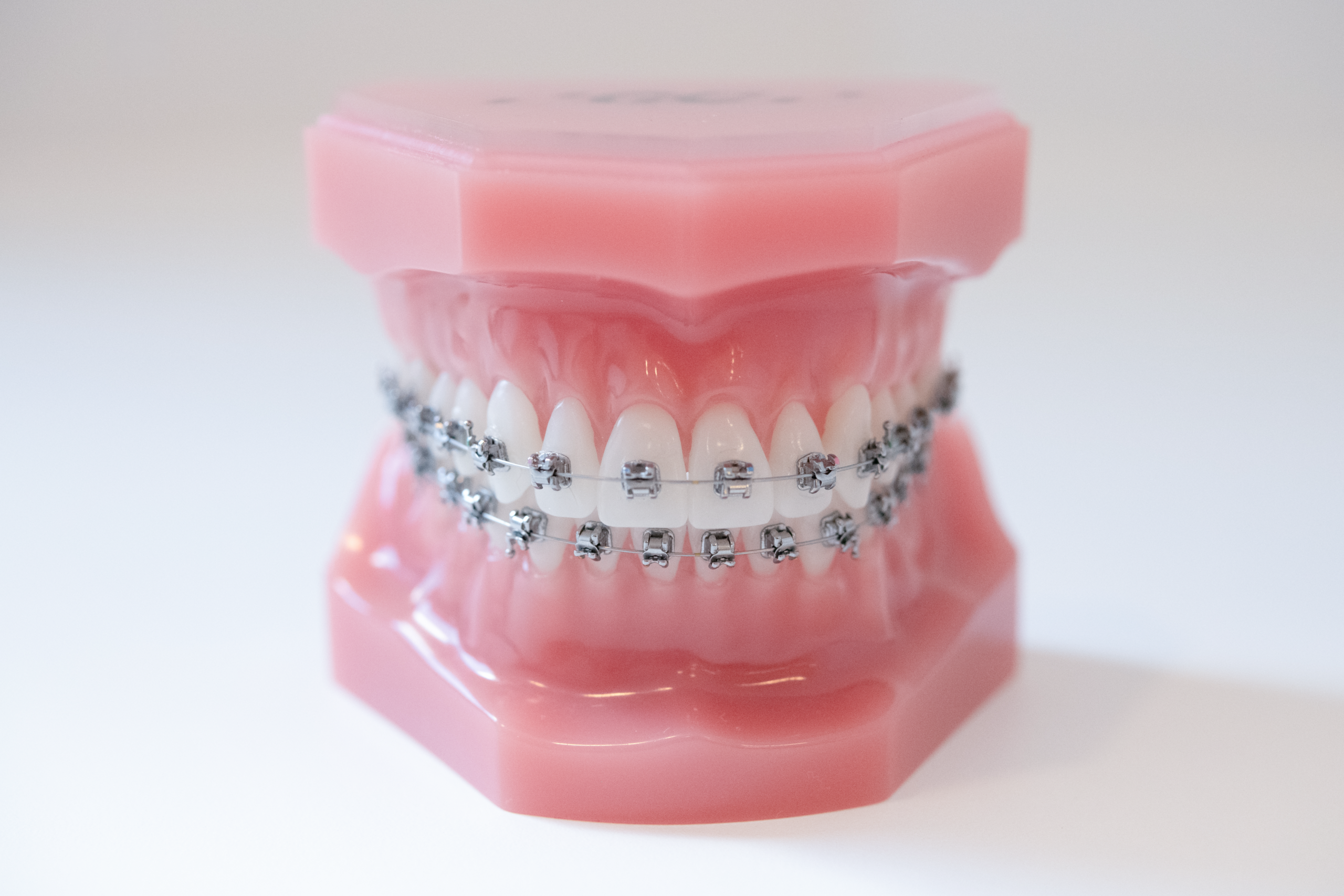 Modell eines Gebisses mit fester Zahnspange und Metallbrackets zur kieferorthopädischen Behandlung.