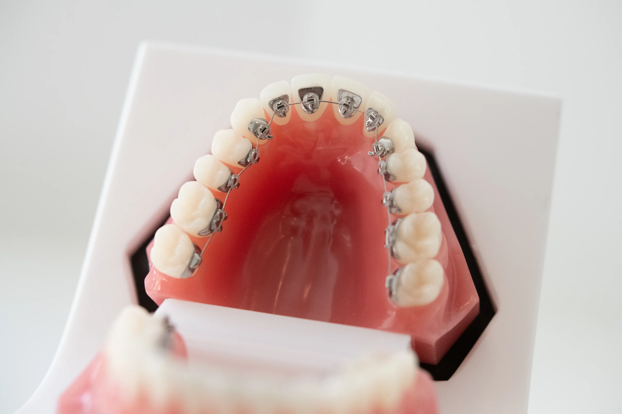 Modell eines Oberkiefers mit festsitzender Zahnspange und Brackets zur kieferorthopädischen Behandlung.